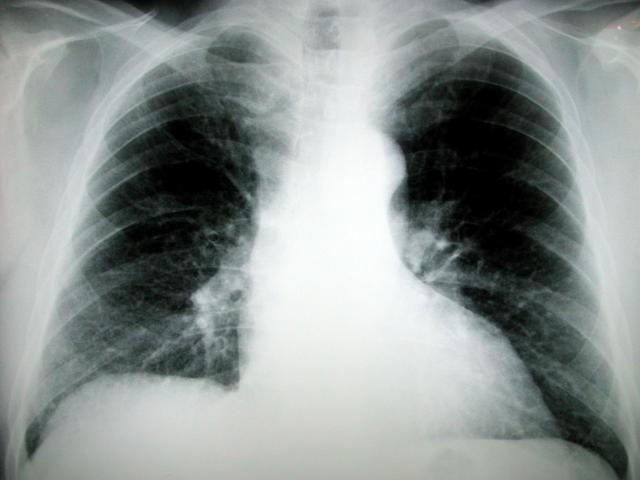 chestCN9697.jpg